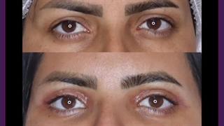 بلفاروپلاستی