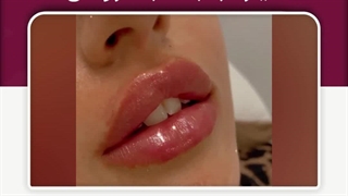 تزریق فیلر لب - سبک روسی