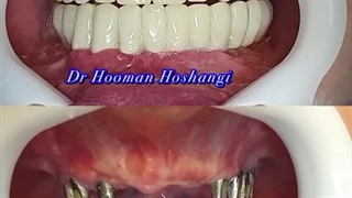 ایمپلنت در تهران