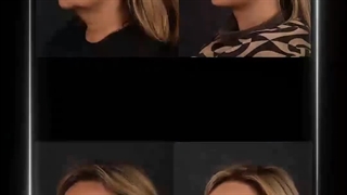 جراحی همزمان لیفت صورت و رینوپلاستی