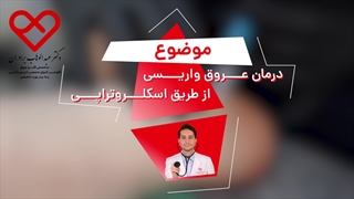 درمان عروق واریسی از طریق اسکلروتراپی