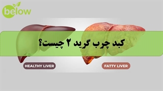 کبد چرب گرید 2 چیست؟