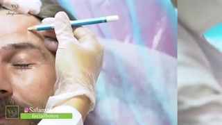 قیمت بوتاکس در مشهد چقدر است؟