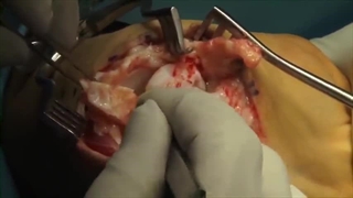 عمل جراحی کین باخ به روش ایمپلنت