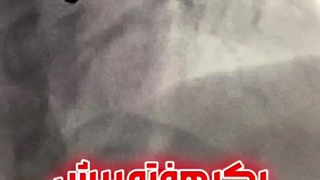 درمان بیمار 60 ساله با آنژیوپلاستی