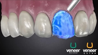 کامپوزیت دندان