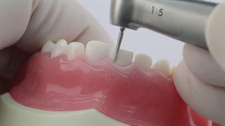 روکش زیرکونیا