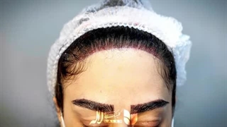 کاشت شقیقه و ابرو با موی بلند