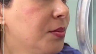 تجربه من از کاشت ابرو طبیعی در کلینیک آندیا