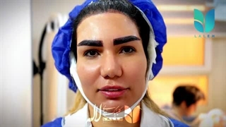 کاشت موی سر بانوان