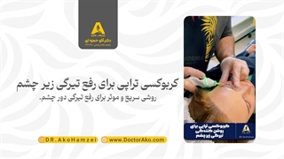 کربوکسی تراپی برای رفع تیرگی زیر چشم در مطب دکتر آکو حمزه ای جرمگیری