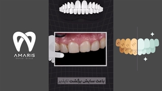 مضرات خمیردندان سفید کننده