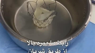 تعویض دریچه قلب به روش تاوی