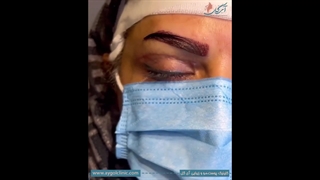 کاشت ابرو بدون درد و با ماندگاری بالا – تجربه‌ای فوق‌العاده!