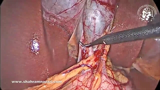 استنت‌گذاری  مجرای صفراوی مشترک  پس از خارج کردن سنگ از مجرای صفراوی مشترک