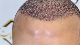 کاشت مو با تراکم بالا همراه با خط رویش طبیعی